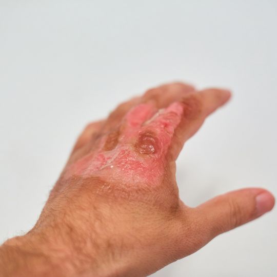 Hauppauge Burn Accidents • Liga de Justicia Injury Lawyers